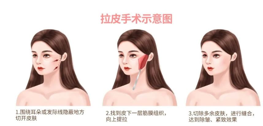拉皮手术实话大公开，你不了解的你所担心的都有解答！
